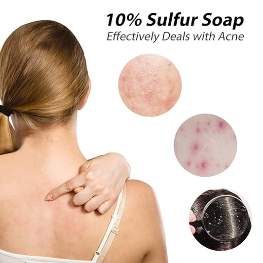 Is good to use sulfur soap for body wash in Summer?